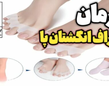 راه درمان انحراف انگشتان پا چیست؟