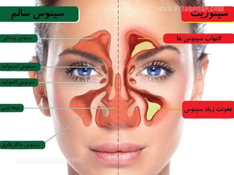 نشانه های سینوزیت شستشوی آن به وسیله ی سینوس واش نشانه های سینوزیت شستشوی آن به وسیله ی سینوس واش