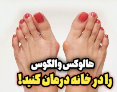درمان بیماری هالوکس والگوس در خانه!!
