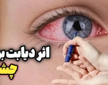 اثرات دیابت بر چشم