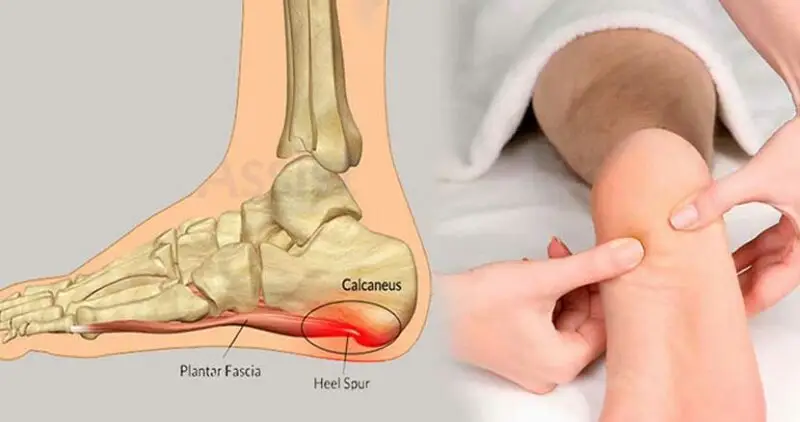 خار پاشنه چیست و چه علائمی دارد؟ خار پاشنه چیست و چه علائمی دارد؟