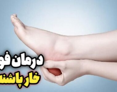 خار پاشنه چیست و چه علائمی دارد؟