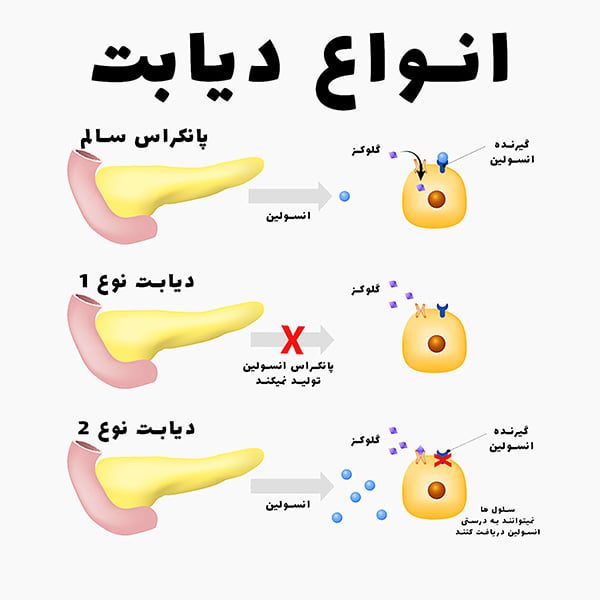دیابت و چالشهای نداشتن دستگاه قند خون دیابت و چالشهای نداشتن دستگاه قند خون